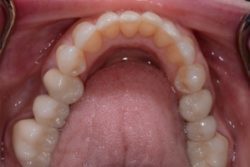 After Invisalign treatment in Medford, NJ