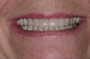 After Dental Crown Treatment