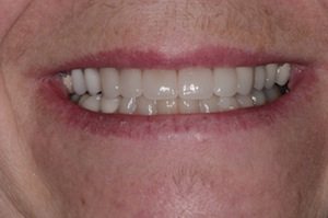 After Dental Crown Treatment
