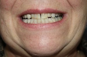 Before Dental Crown Treatment