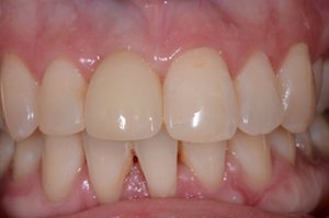 After Dental Implant Treatment by Medford, NJ Dentist Dr. Parnaik