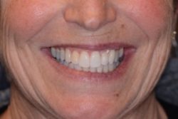 After Invisalign clear aligners for crooked teeth