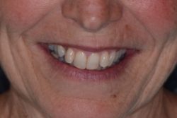 Before Invisalign clear aligners for crooked teeth