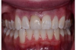 After Single Tooth Porcelain Crown