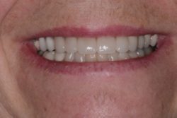 After Dental Crowns treatment in Medford, NJ