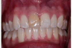 Before Single Tooth Porcelain Crown