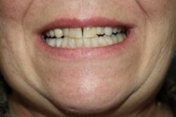 Before Dental Crowns treatment in Medford, NJ