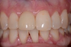 After Dental Implants for front tooth