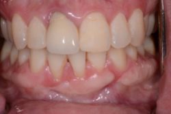 Before Dental Implants for front tooth