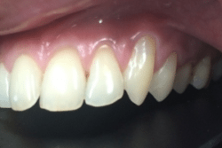 Canine Gum Recession treatment in Burlington County, New Jersey