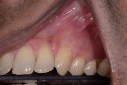 Canine Gum Recession treatment in Medford NJ