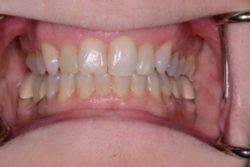 After Invisalign treatment in Medford, NJ