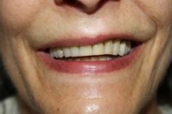 After veneers in Burlington County, New Jersey