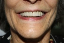 Before dental veneers in Burlington County, New Jersey