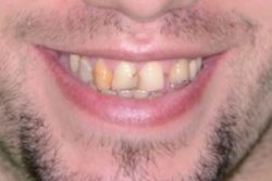 before Porcelain Dental Crowns