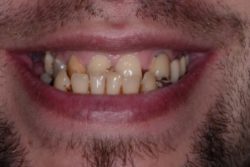 after Porcelain Dental Crowns