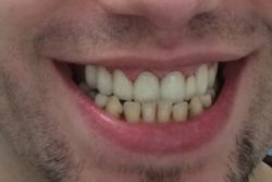 after Porcelain Dental Crowns in Burlington County, New Jersey