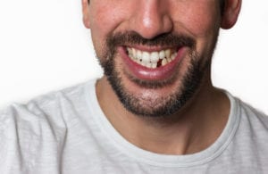 4 Reasons To Choose Dental Implants To Restore Your Smile