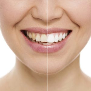 Affordable teeth whitening in Medford, NJ