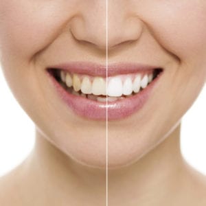 Teeth whitening, Medford, NJ