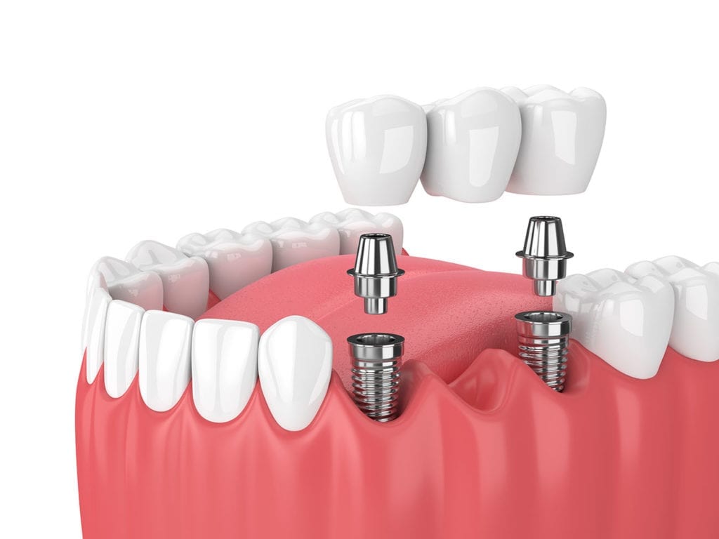 dental bridge implant supported bridge medford nj