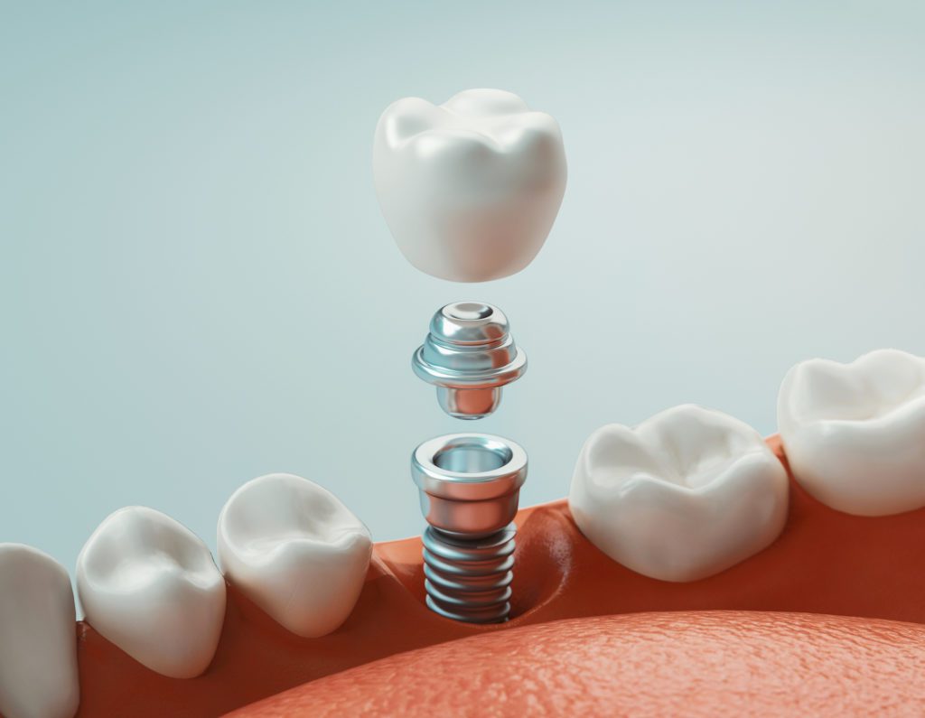 questions about dental implant in Medford, NJ