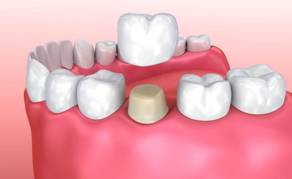 Dental crown installation process 3d render of installation restorative dentistry dentist in Medford New Jersey