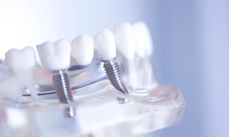 Whether your dental bridge is fixed, removable, or supported by implants, proper care is essential to maintain its longevity.