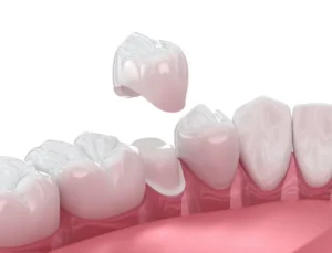 Times Your Dentist May Suggest a Dental Crown in Medford, NJ